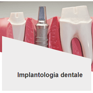 Impianti dentali: la soluzione definitiva per i denti mancanti