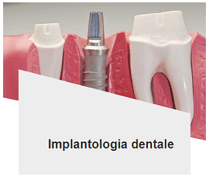 Impianti dentali: la soluzione definitiva per i denti mancanti