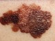 Loano, prevenzione del melanoma: aperte le prenotazioni per le visite dermatologiche gratuite