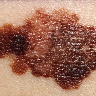 Loano, prevenzione del melanoma: aperte le prenotazioni per le visite dermatologiche gratuite