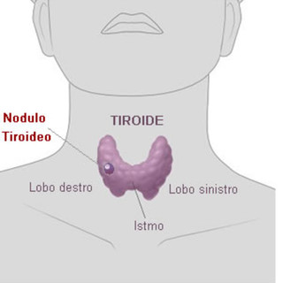 Albenga, &quot;Progetto tiroide&quot; di Fondazione ANT: il 10 dicembre una giornata di visite gratuite per la prevenzione oncologica