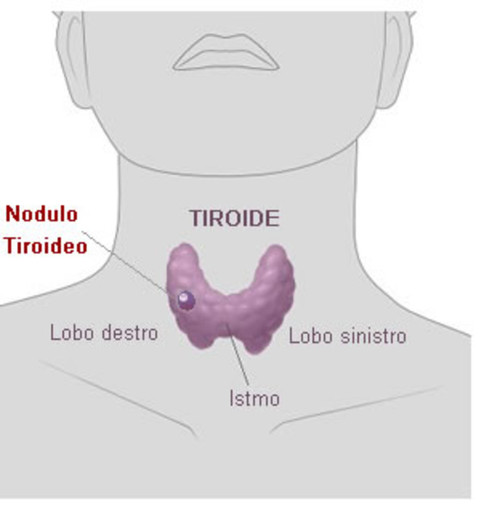 Albenga, &quot;Progetto tiroide&quot; di Fondazione ANT: il 10 dicembre una giornata di visite gratuite per la prevenzione oncologica